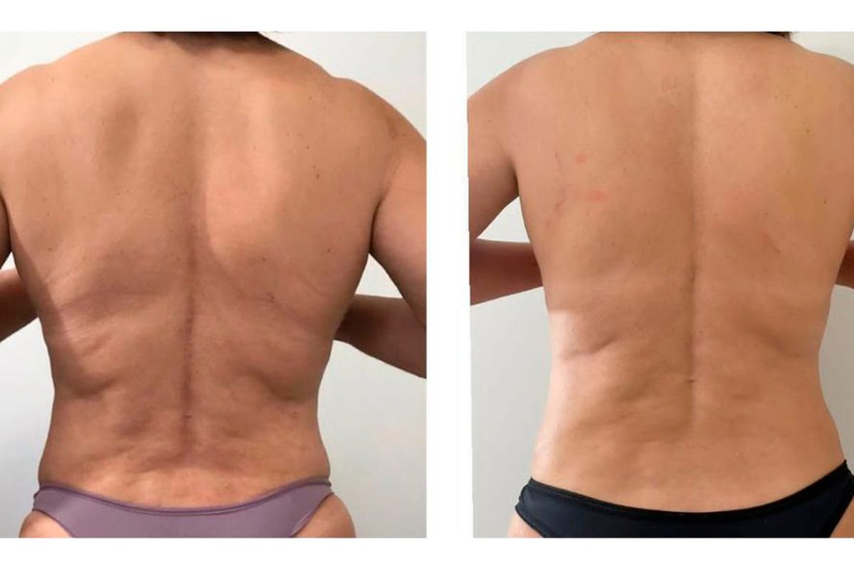 Costas antes e após 2 sessões de Refreeze e Cryo RF Max do Unyque PRO