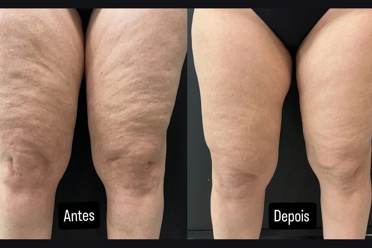 Antes e depois do Unyque PRO: coxas
